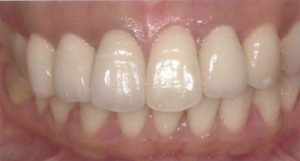 オールセラミック治療後